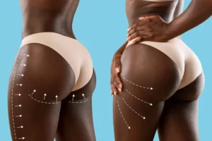 Byinshi kuri ‘Brazilian Butt Lift’, uburyo burimbisha ikibuno bwahuruje Abanyafurika
